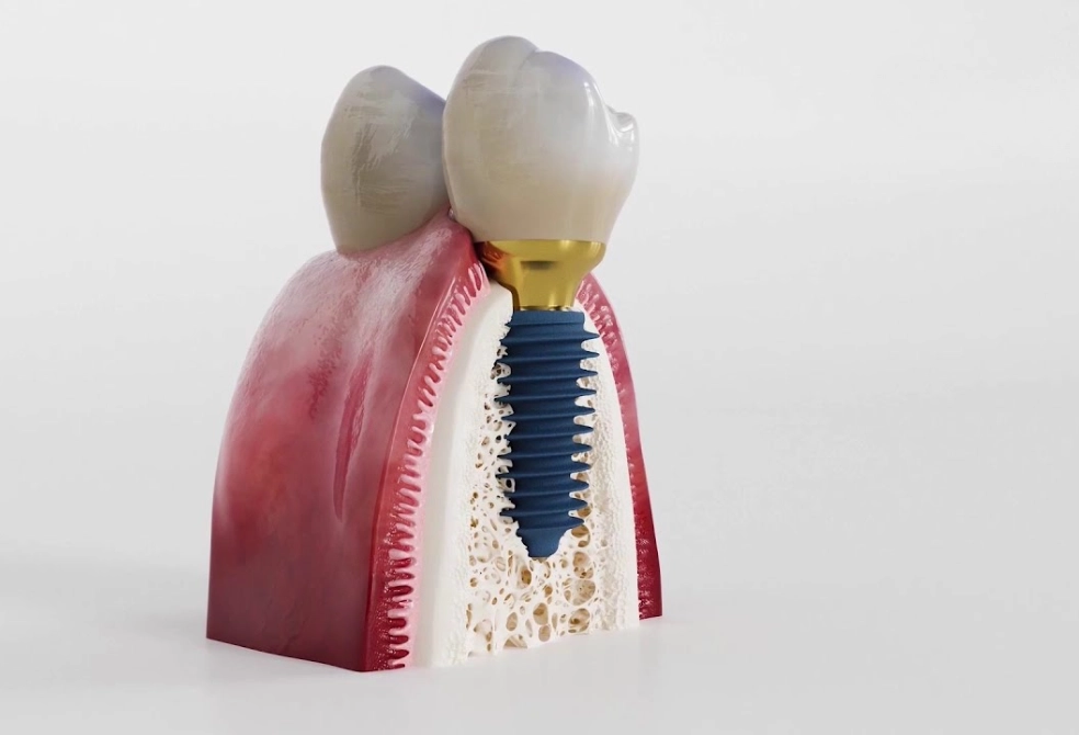 Megagen Dental Implants