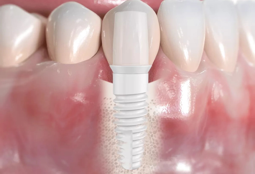 Megagen Dental Implants
