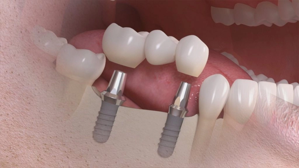 Megagen Dental Implants