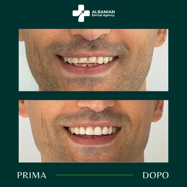 Dhëmbë të këqij para dhe pas