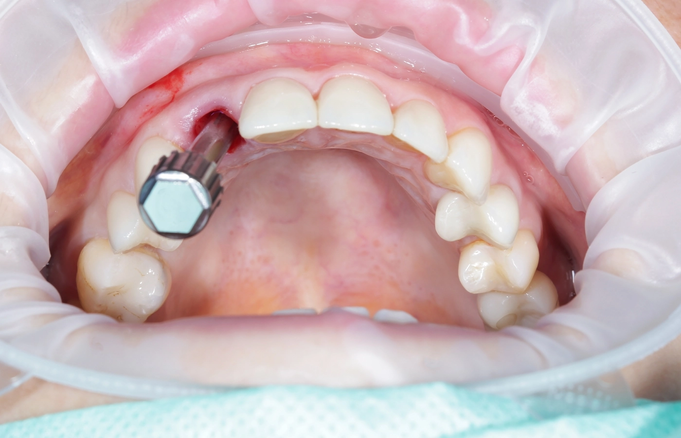 4 Types of Dental Implants, Updated 2025 Guide