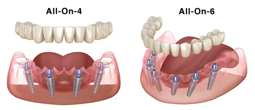 All on 6 vs All on 4 Implants: Which Is Right for You?