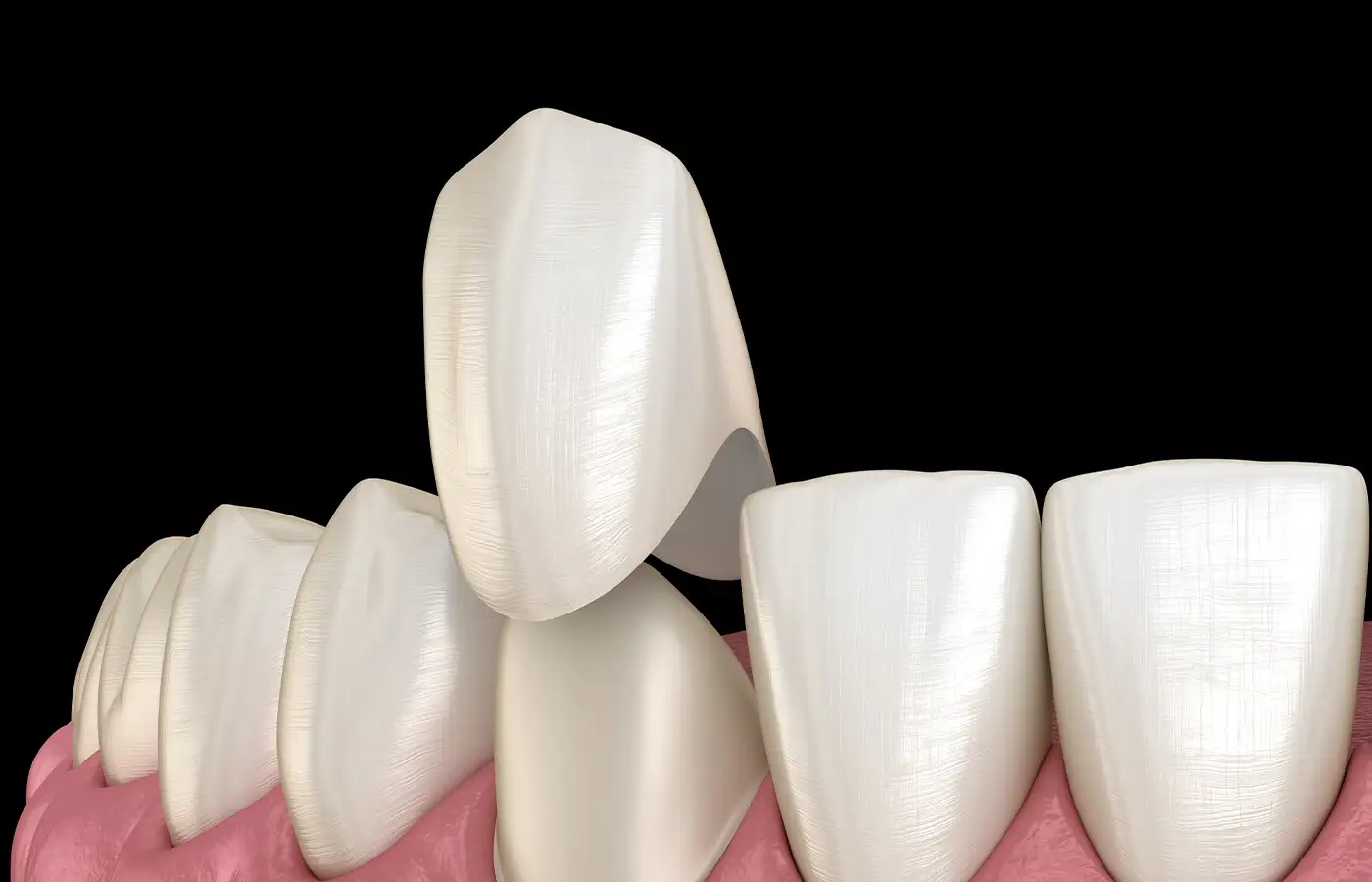 Best Types of Dental Crowns: A Comprehensive Guide for Patients