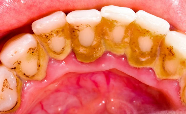 Come eliminare la placca dentale in 5 minuti: guida completa