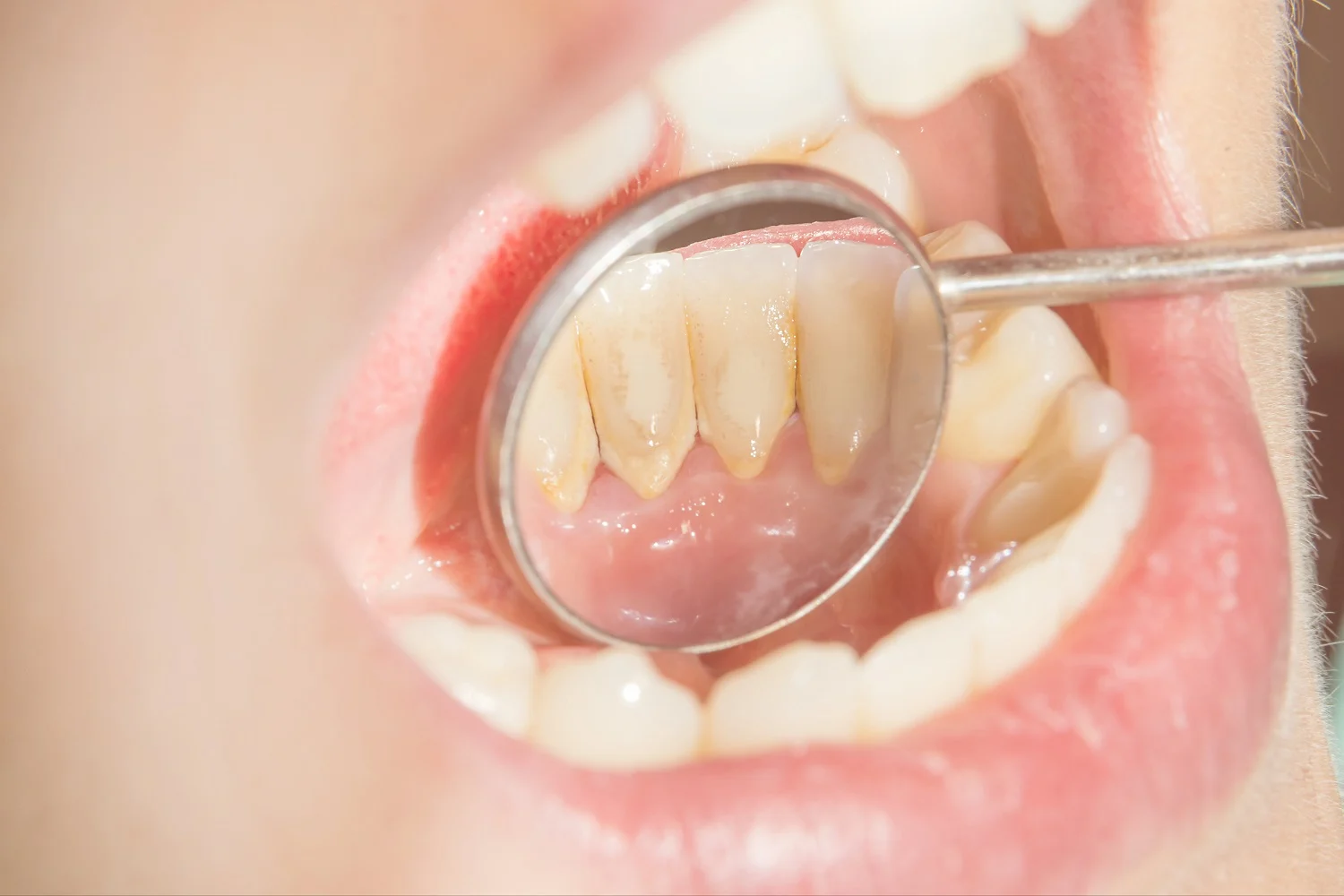¿Cómo Quitar el Sarro de los Dientes?