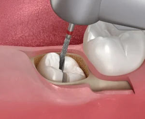Quanto costa l'estrazione del dente del giudizio