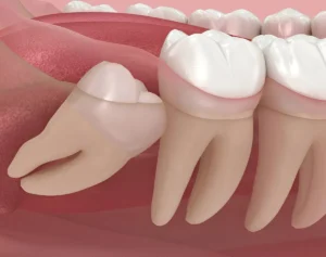 Quanto costa l'estrazione del dente del giudizio