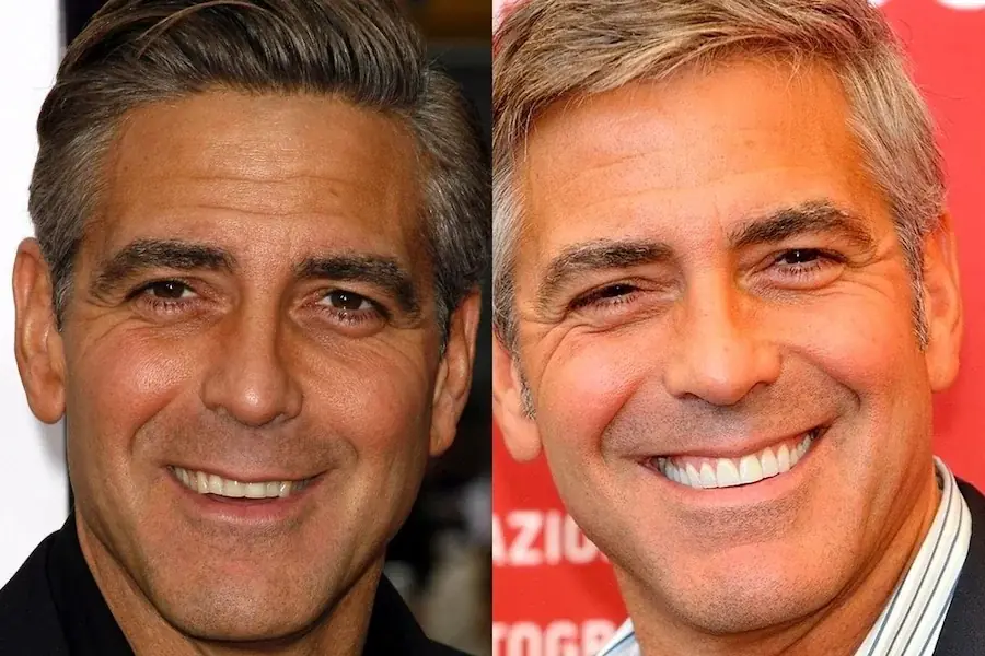 Reports suggest that Clooney suffered from bruxism, a condition characterized by teeth grinding, which led to significant wear on his teeth.