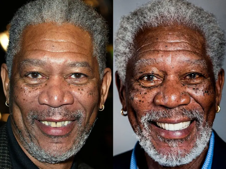 Morgan Freeman dental implants before and after