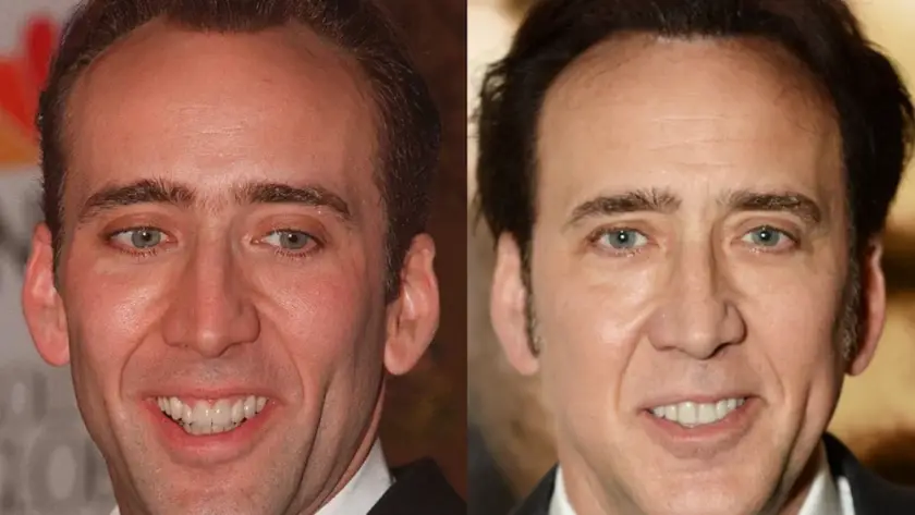 Nicolas Cage, known for his eclectic roles and unique style, reportedly opted for dental implants as part of his transformation for the film Birdy. Cage's commitment to his craft extended to improving his dental appearance, showcasing how implants can align with professional requirements and personal goals. His experience highlights the role of dental aesthetics in character development.
