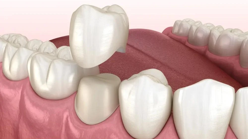 Corona Dentale