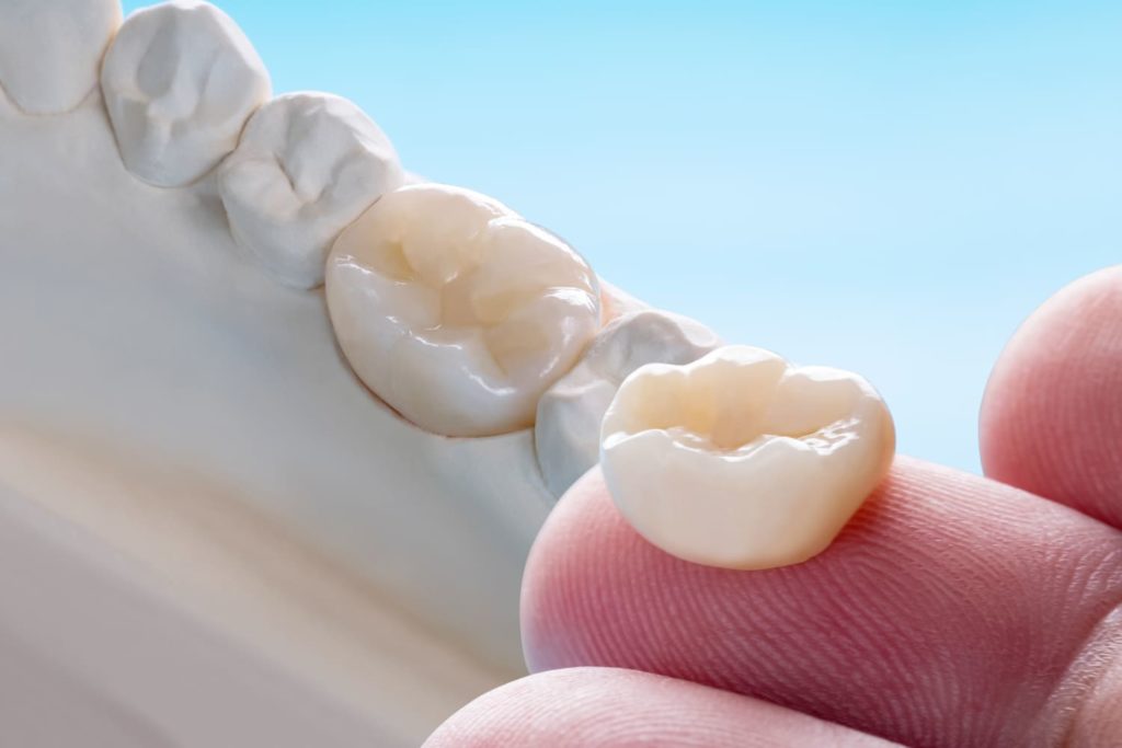 Corone in zirconio vs porcellana