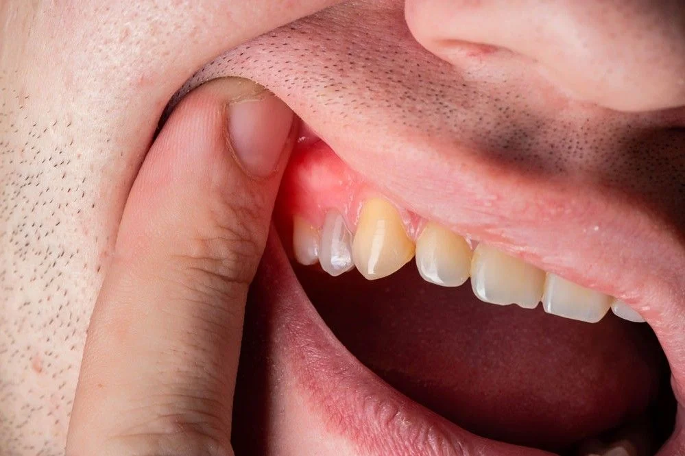 Cosa fare per ascesso dentale: sintomi, rimedi e trattamenti definitivi