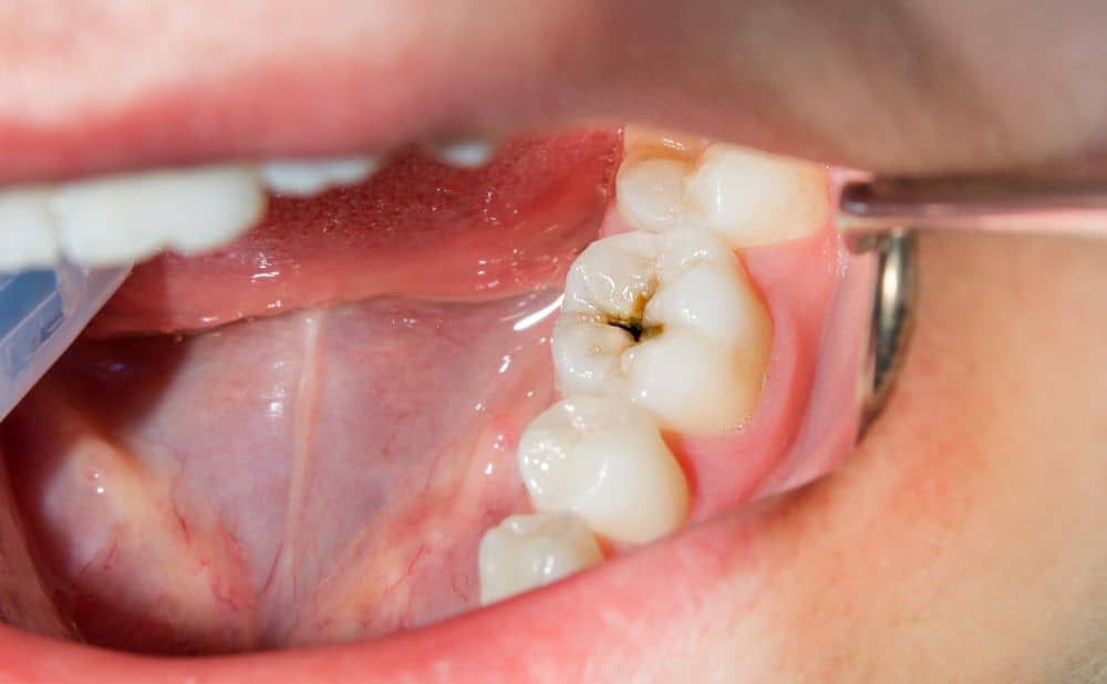 Cosa prendere per il mal di denti: farmaci, rimedi naturali e soluzioni definitive