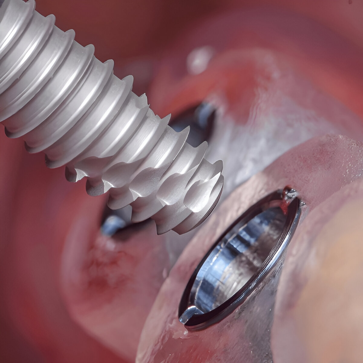 Dental Bridge vs Implant: An In-Depth Comparison for a Healthier Smile