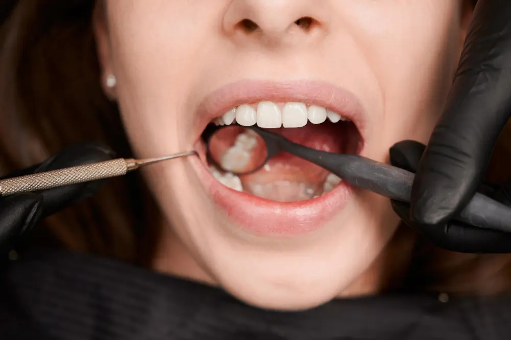 How long does it take to fill a cavity ?