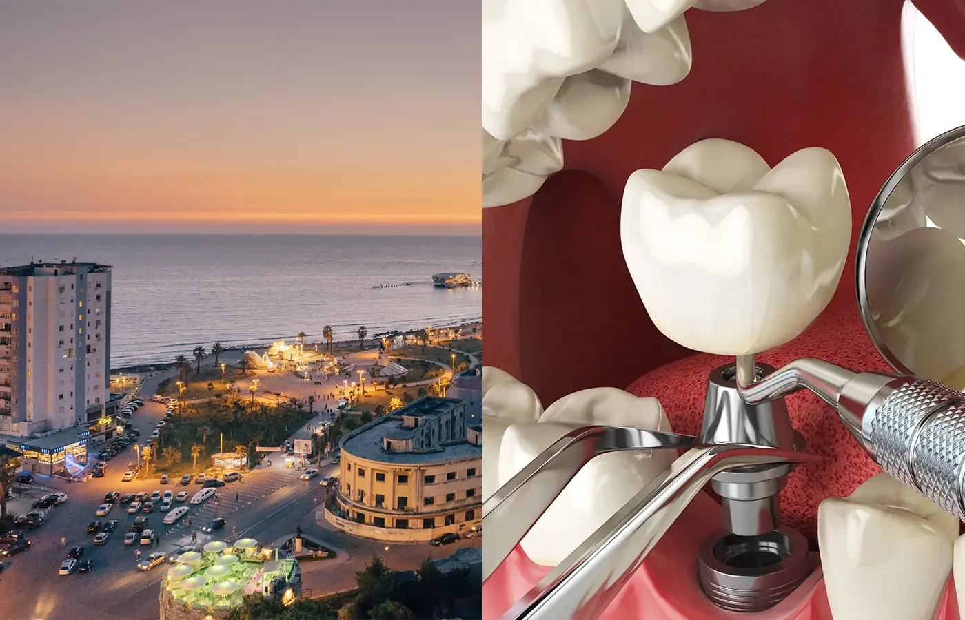 How Much is a Full Set of Dental Implants in UK and Why Albania is Better?