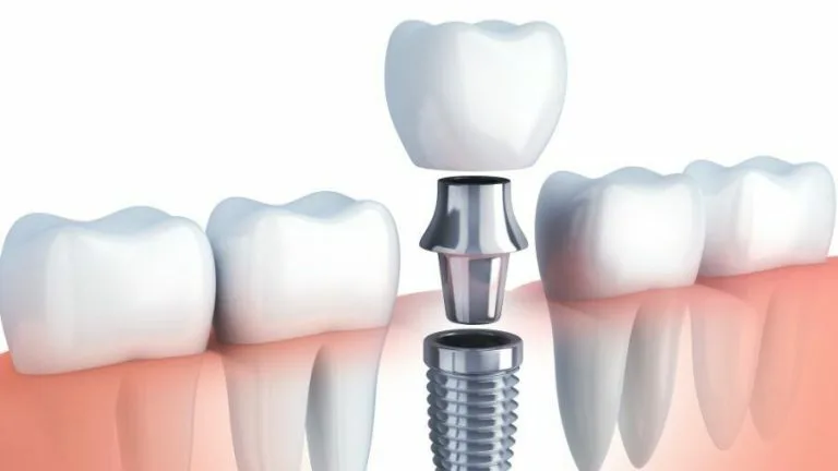 Impianti in Zirconia vs Titanio: Differenze, Vantaggi e Quale Scegliere per il Tuo Sorriso