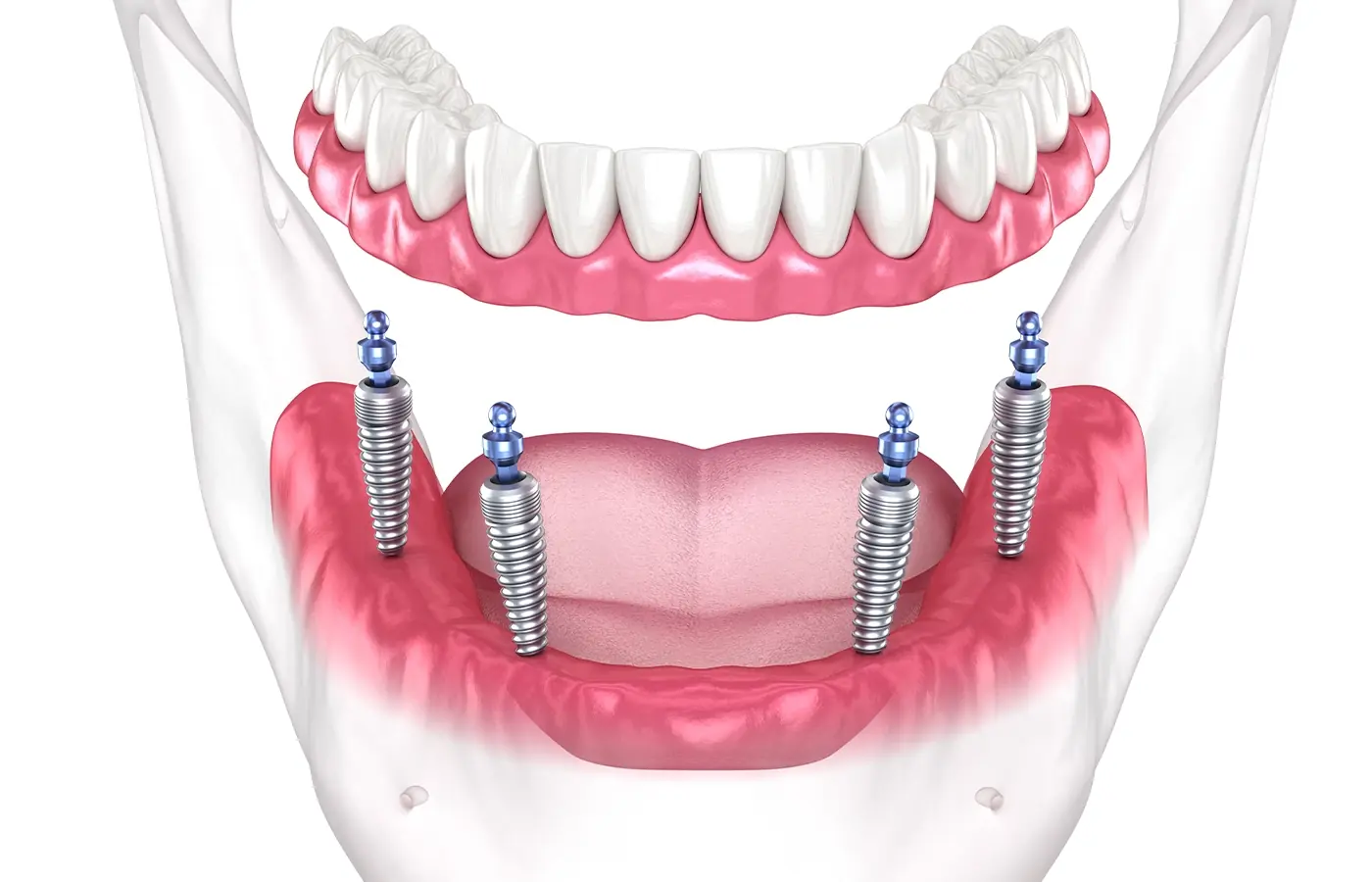 Impianto Dentale e Dolore: Sfatando Tutti i Miti