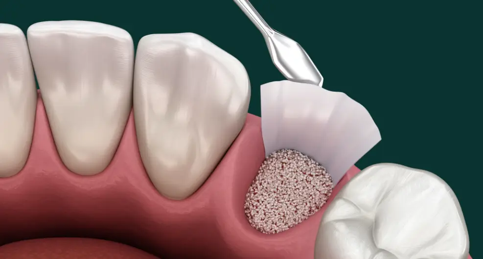 Osso Dentale