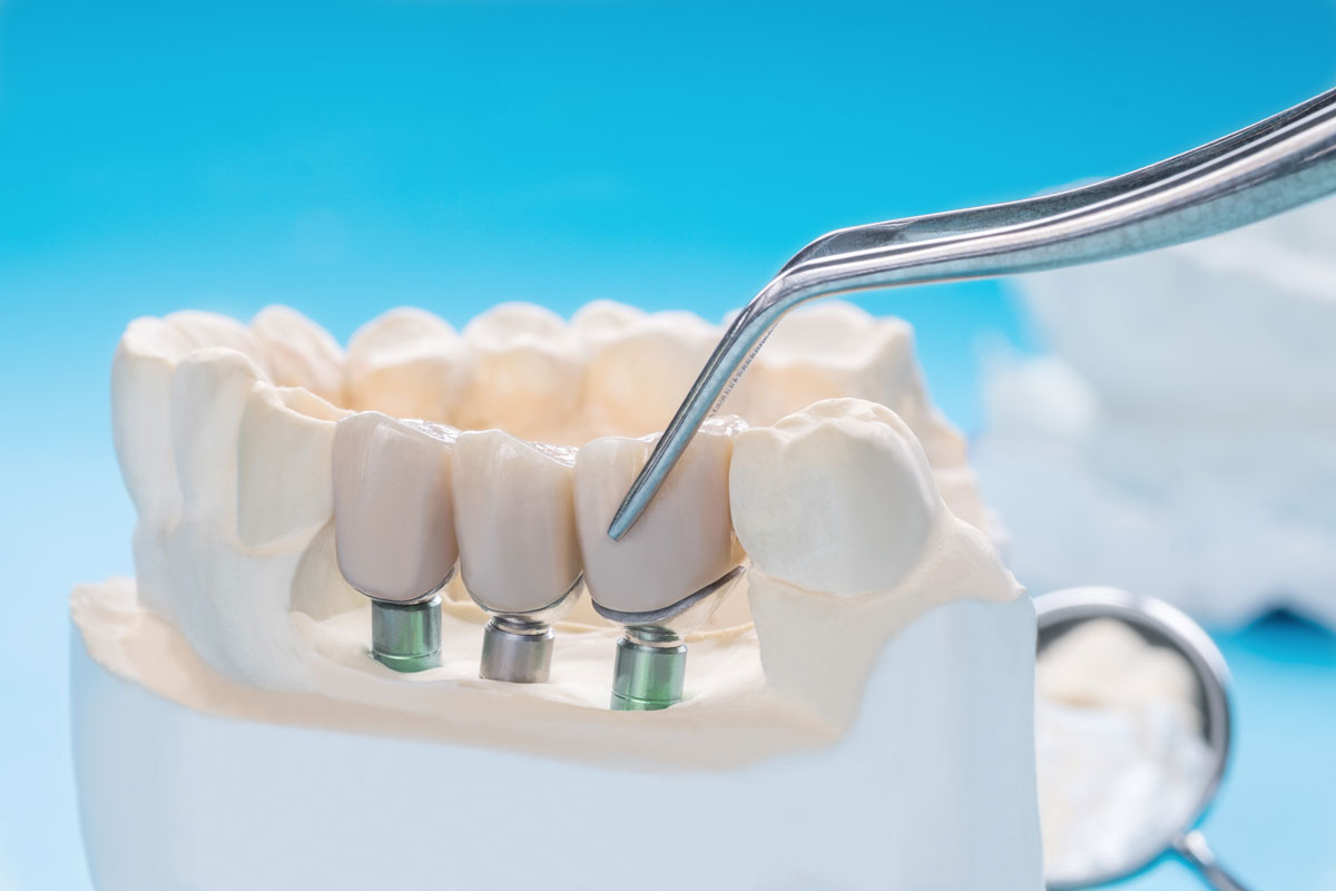 Quanto costa una capsula dentale in resina? Prezzi, caratteristiche e alternative