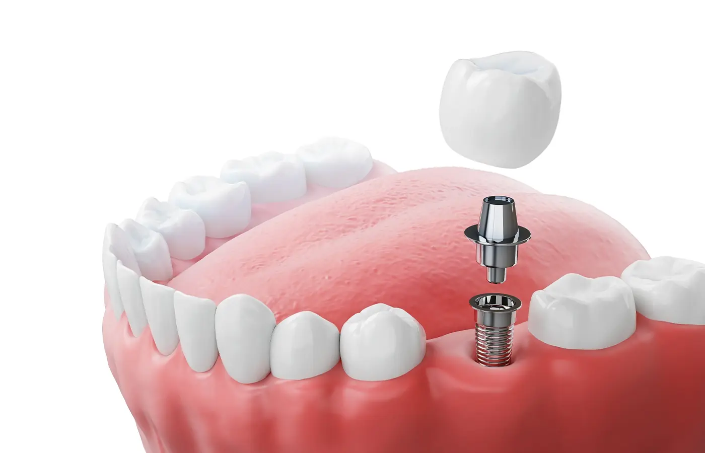 Sensazione Strana Dopo Impianto Dentale: Cosa Sapere e Come Agire