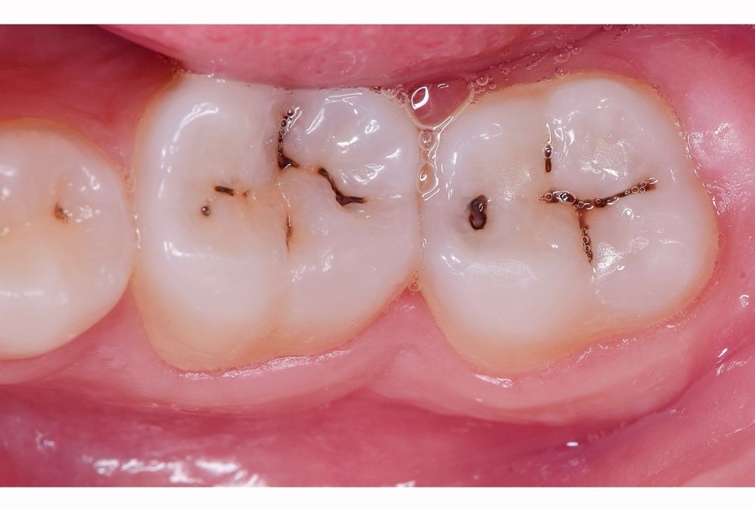 Symptoms & Prevention of Tooth Decay