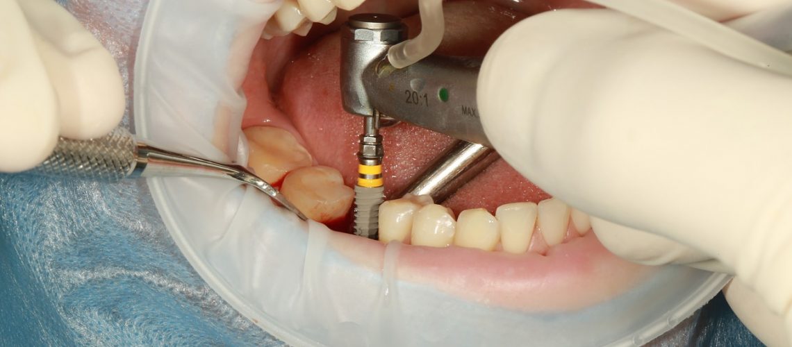 What to Expect After Your All on 6 Dental Implant Surgery