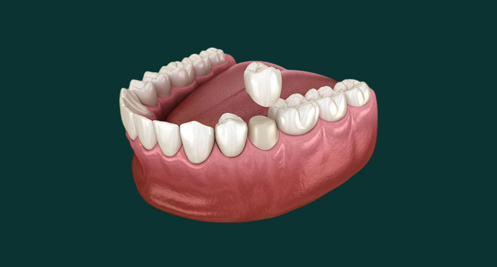 Një kurorë mbi dhëmbin origjinal