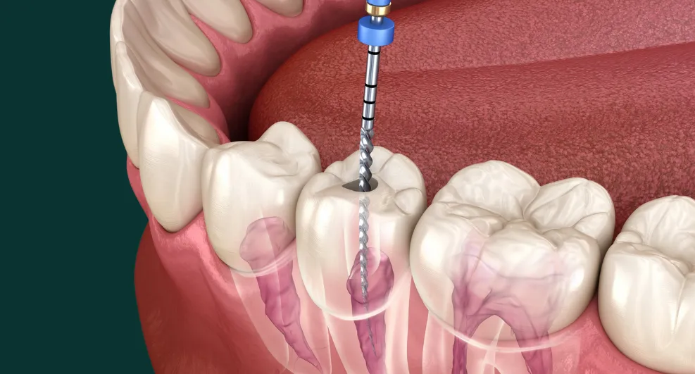 Ritrajtimi endodontik