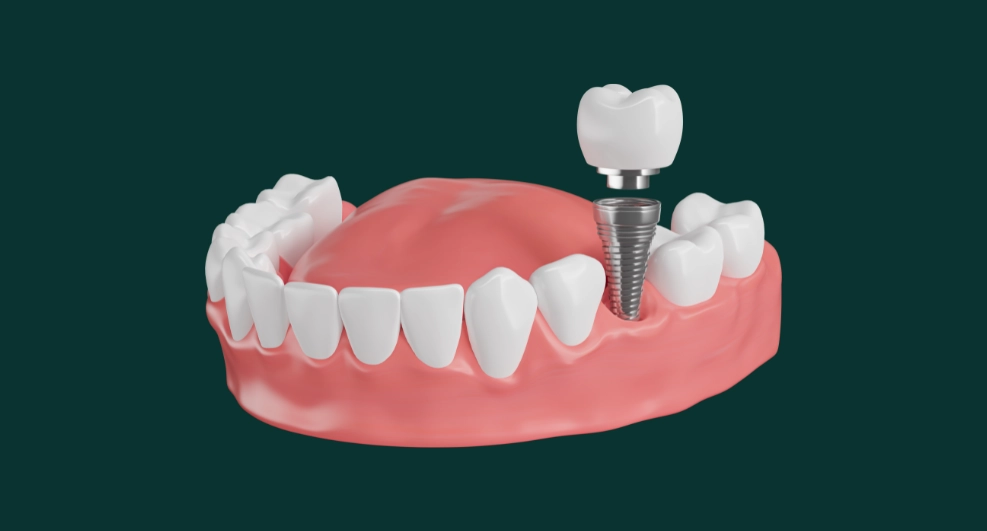 Eine Krone auf einem Implantat