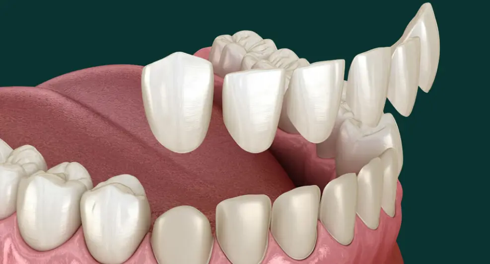 Ceramic veneers