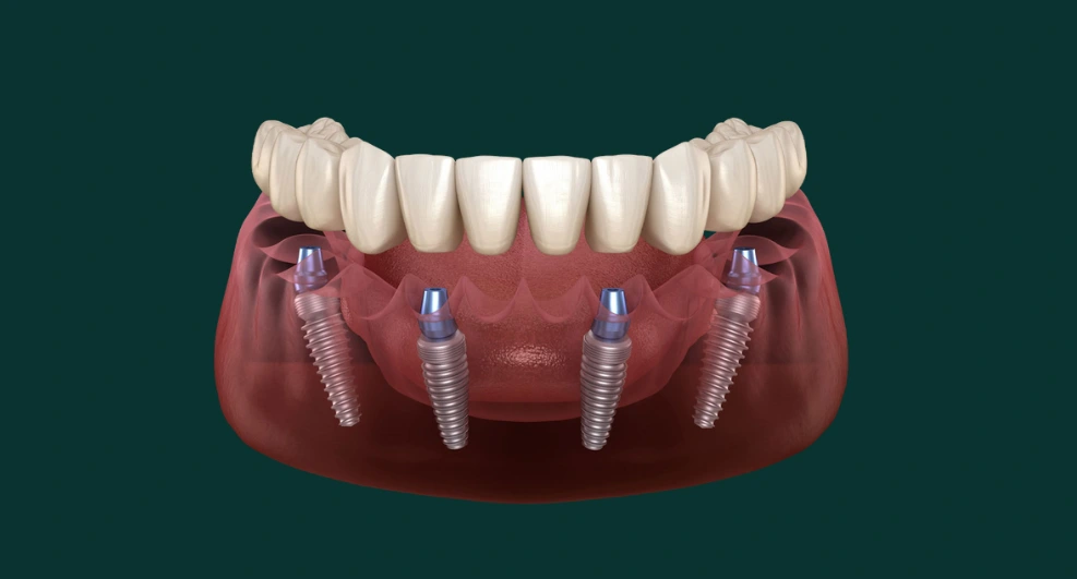 All on 4 dental implants