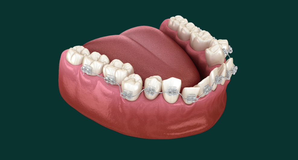 Dental Braces