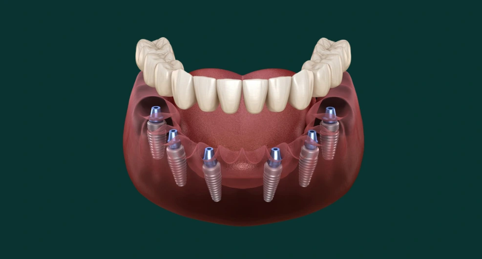 All on 6 Dental Implants