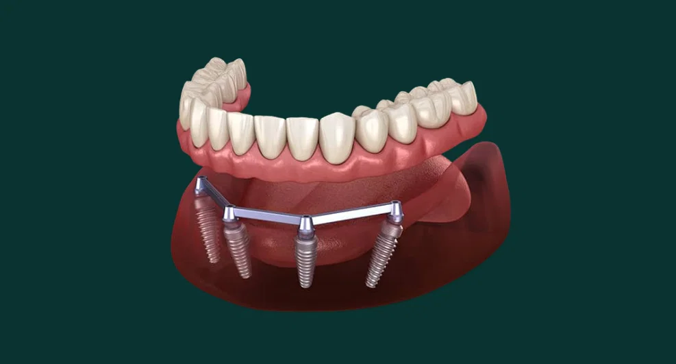 Overdenture prosthesis with bar on implants
