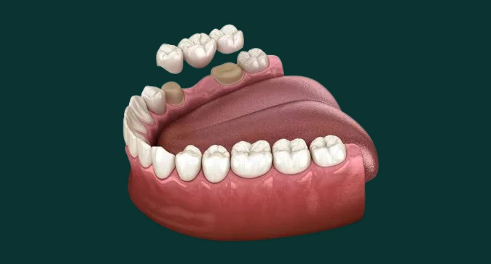 Puente sobre dientes naturales