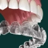 Dental Aligners