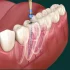 Endodontic Retreatment