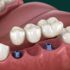 A ceramic bridge supported by implants