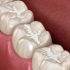 Ceramic fillings