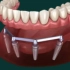 Overdenture prosthesis with bar on implants