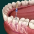 Root Canal Treatment