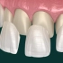 Ceramic veneers