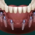 All on 6 Dental Implants