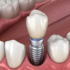 A crown on an implant