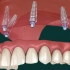 All on 4 dental implants